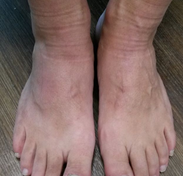 Fuß geschwollen gicht Gicht: Ursachen,